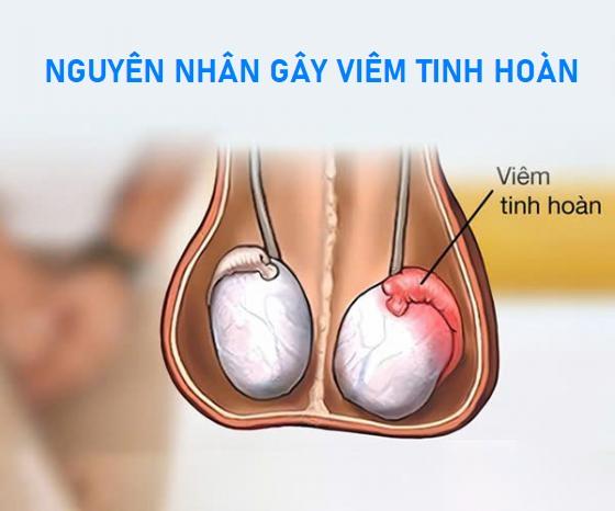 1763021639643398.jpg viem-tinh-hoan-nguyen-nhan.jpg